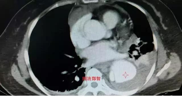 磁共振可以替代cta检查主动脉夹层,主动脉夹层cta上如何分辨真假腔