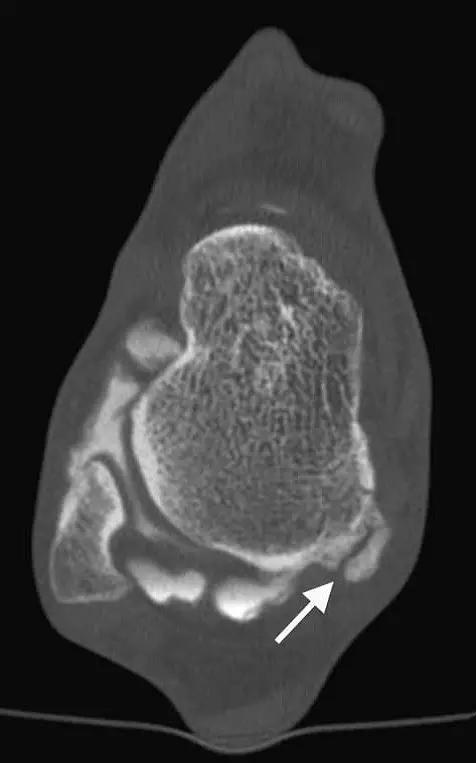 几种严重骨折医学名称,常见的骨折有哪些名称