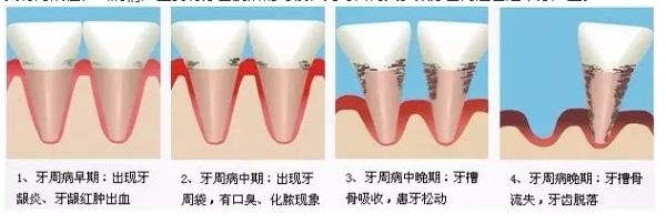 疫情期间怎么做好口腔防护,防控疫情口腔注意事项