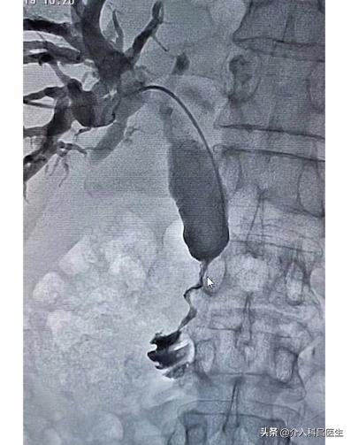 肿瘤导致黄疸,肝脏肿瘤压迫胆管应怎样治疗