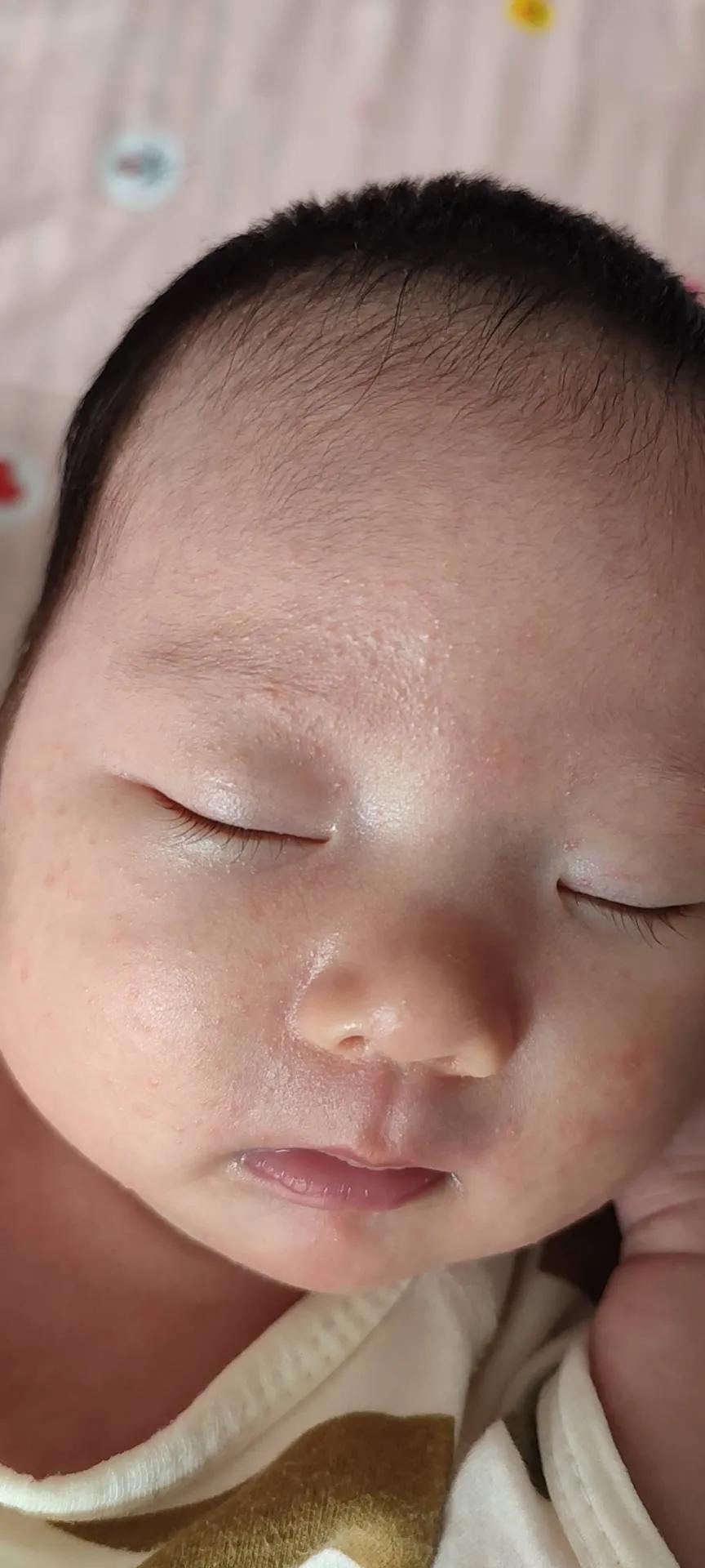 宝宝大作战8-9,宝宝湿疹大作战