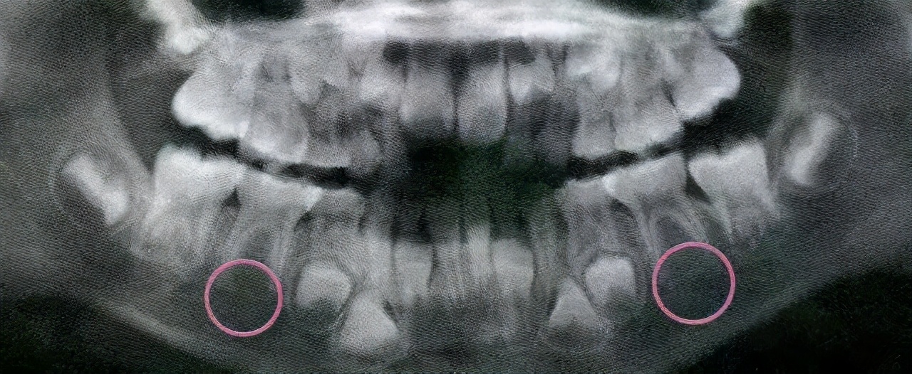 7岁小孩门牙掉了一年没长怎么办,7岁小孩门牙掉了一直不长怎么办