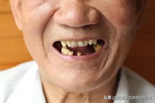 牙周炎牙齿全部掉了好装假牙吗,牙齿掉了安一颗假牙要多少钱