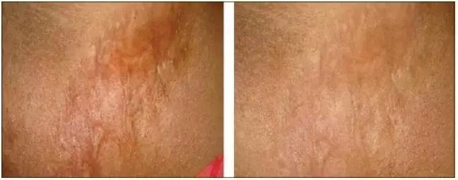 抗疤痕药什么价格,进口祛疤痕药