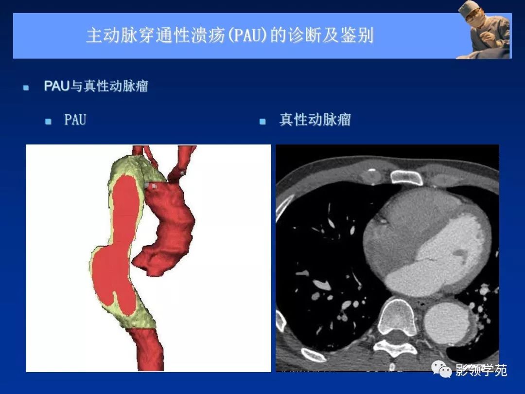 主动脉夹层壁间血肿如何鉴别,主动脉夹层血肿溃疡