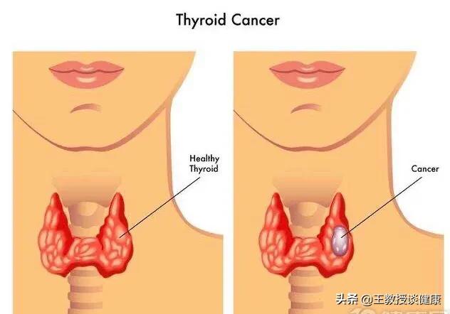 甲状腺癌全切还会复发吗,甲状腺癌全切之后会复发和转移吗
