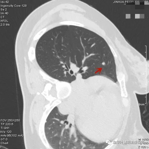 叶建明谈胸膜下的实性结节,叶建明肺实性良性结节会变癌症吗