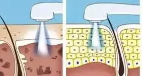 光子嫩肤有关常识,光子嫩肤科普知识