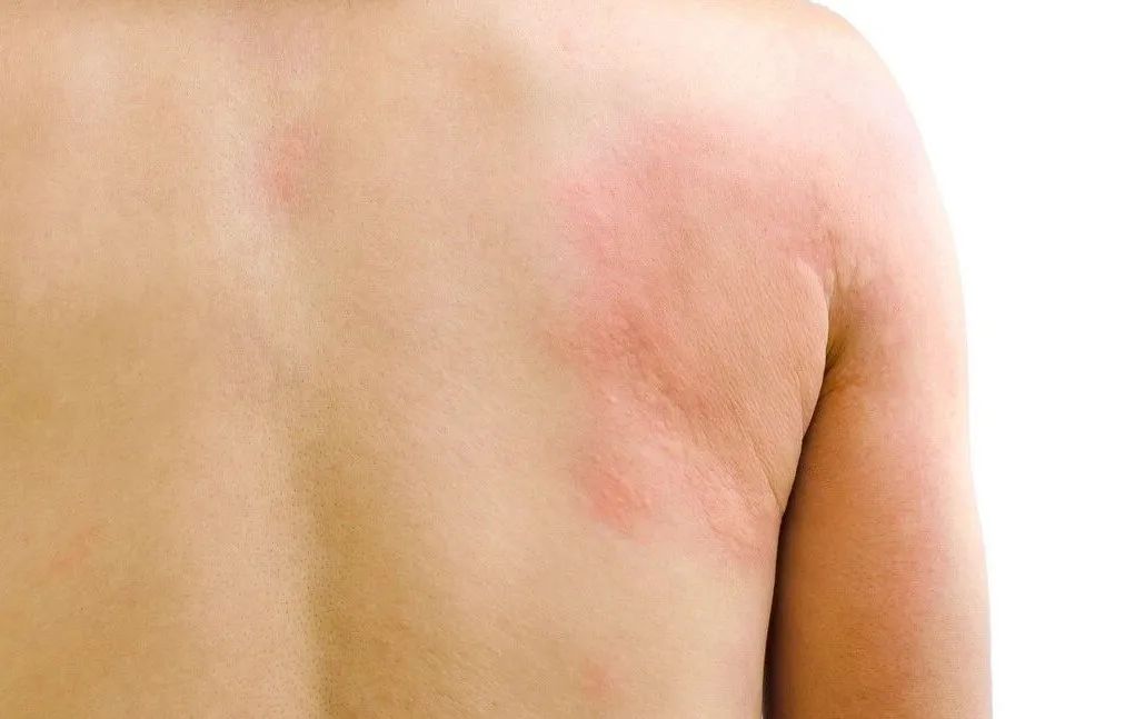 慢性*麻疹荨**的中医辨治思路——祛除络中之风