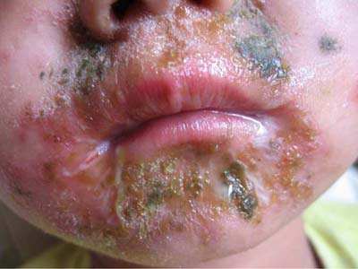 脓疱疮的症状,脓疱疮如何治疗呢其病因是什么