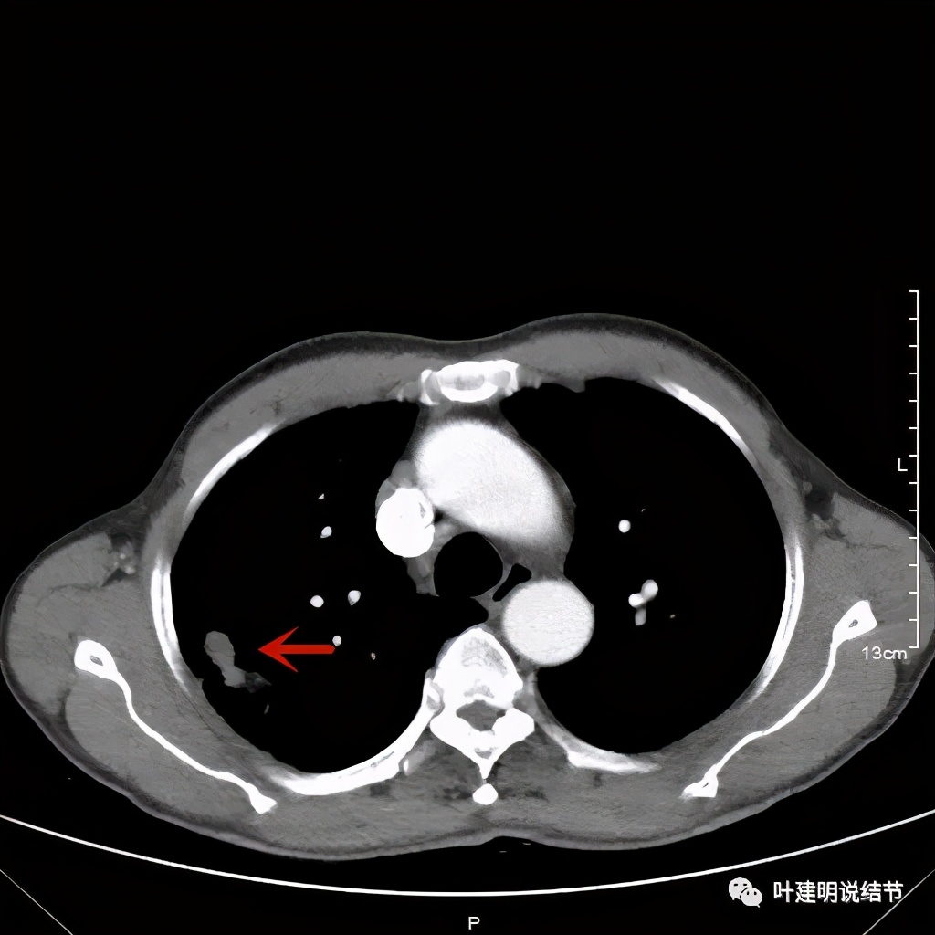 肺占位病理活检无病变,肺部占位穿刺病理说不确定性质