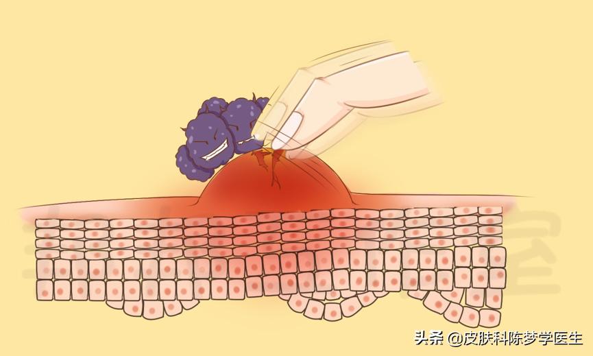 被蚊子叮咬起红包怎么办,被蚊虫咬的红包