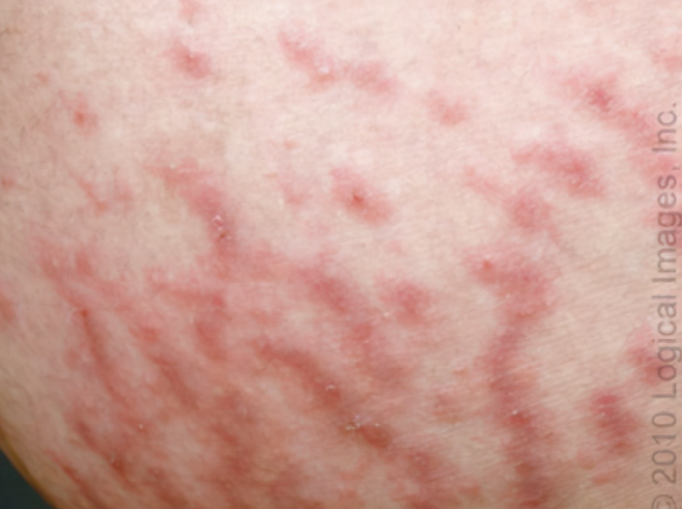 医生推荐防妊娠纹,搞定妊娠纹几十块钱就够了