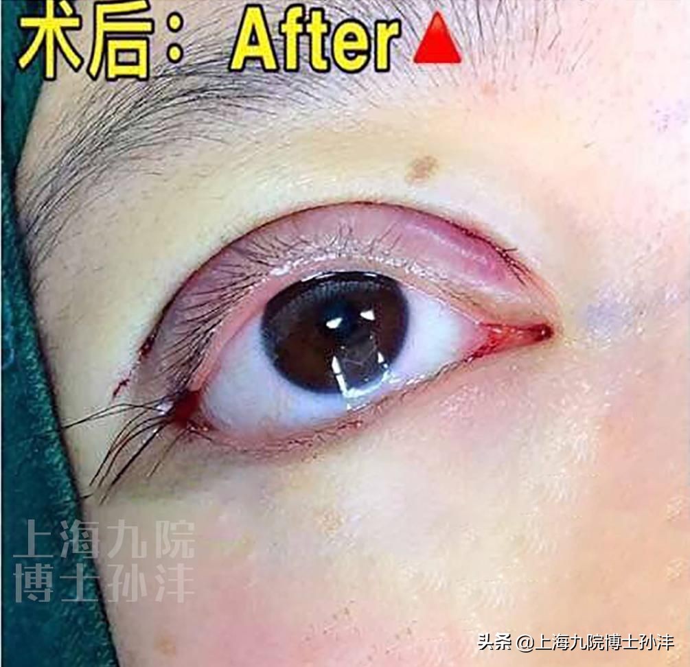 平行双眼皮眼皮薄,多眼皮做双眼皮手术埋线