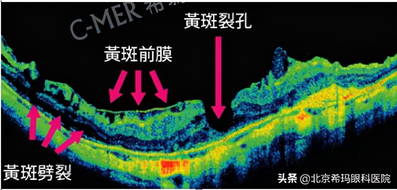 定期查眼底要专家门诊吗,查眼底查哪一项能查出来