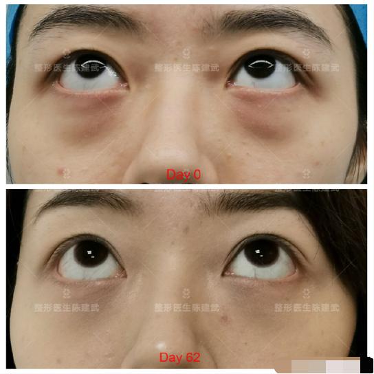 为什么睡那么早眼袋还是那么重,天天睡不好眼圈和黑眼袋特别重