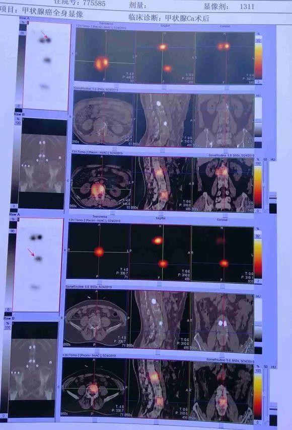 甲状腺结节时间长会转变成癌症吗,两个甲状腺病灶算不算严重