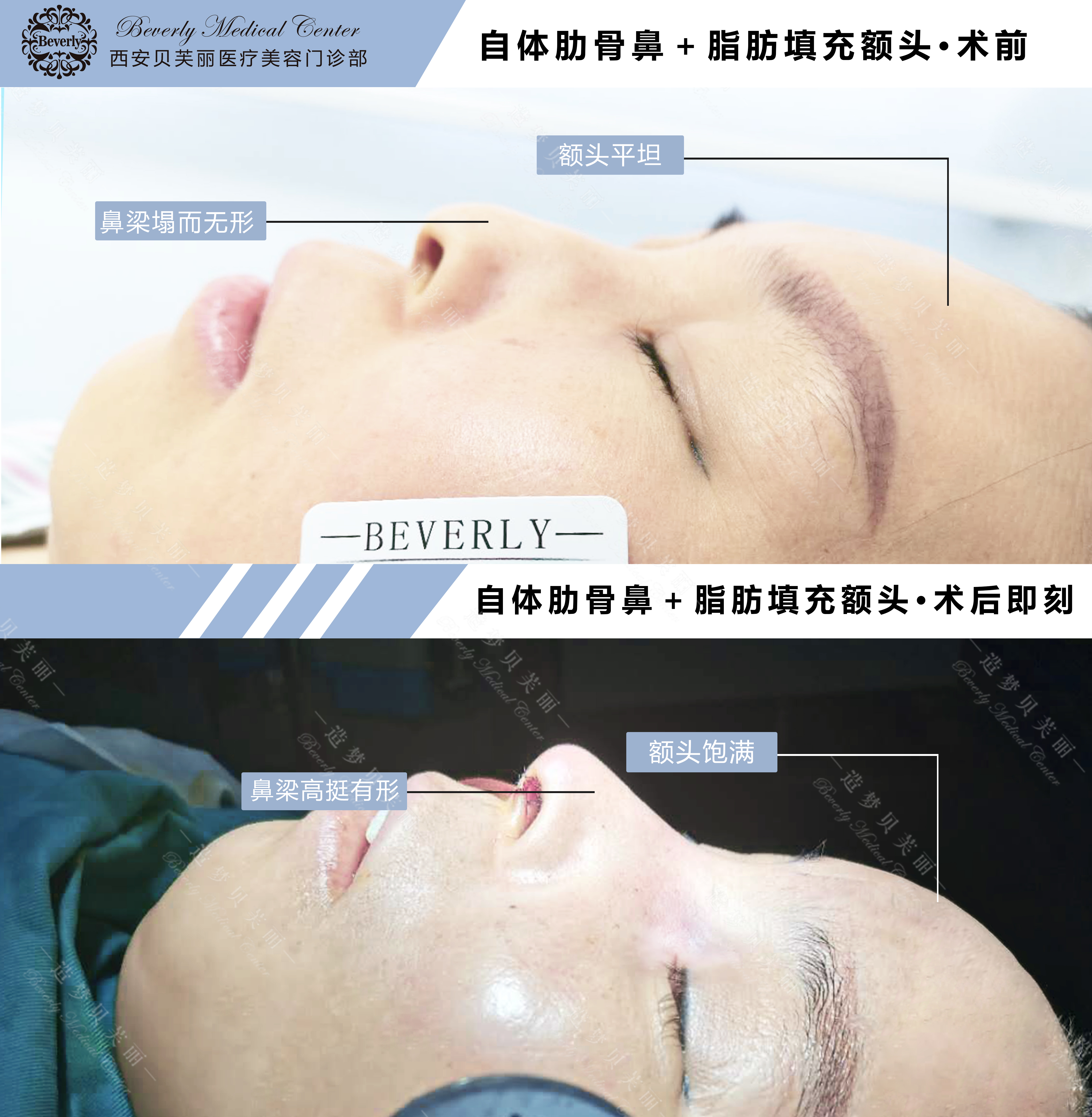 隆鼻术后一个月内可以重新修复吗,专家讲解隆鼻修复手术效果