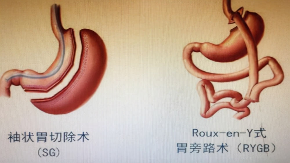 男子切胃,男子做切胃手术