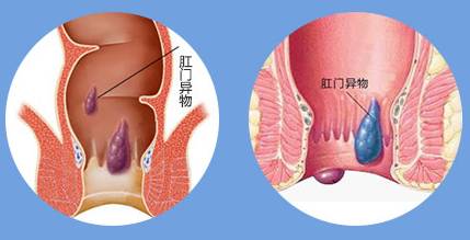 “医生，总感觉肛门不舒服，像夹了个东西，是咋回事？”