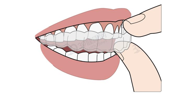 隐形牙套能矫正整齐吗,为什么戴牙套会让人变好看