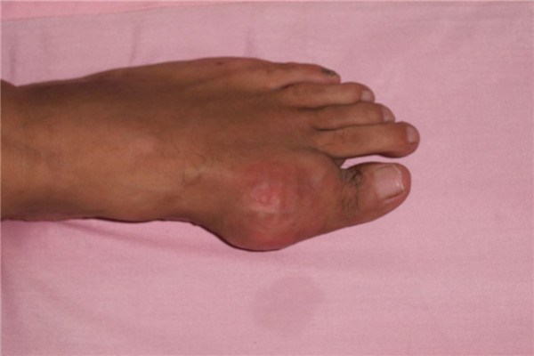 痛风石一般尿酸多少达标,尿酸从612降到532