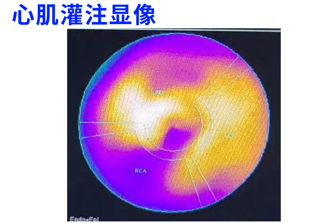 冠脉没有狭窄是否排除心肌缺血,冠脉不堵塞却心肌缺血怎么治疗