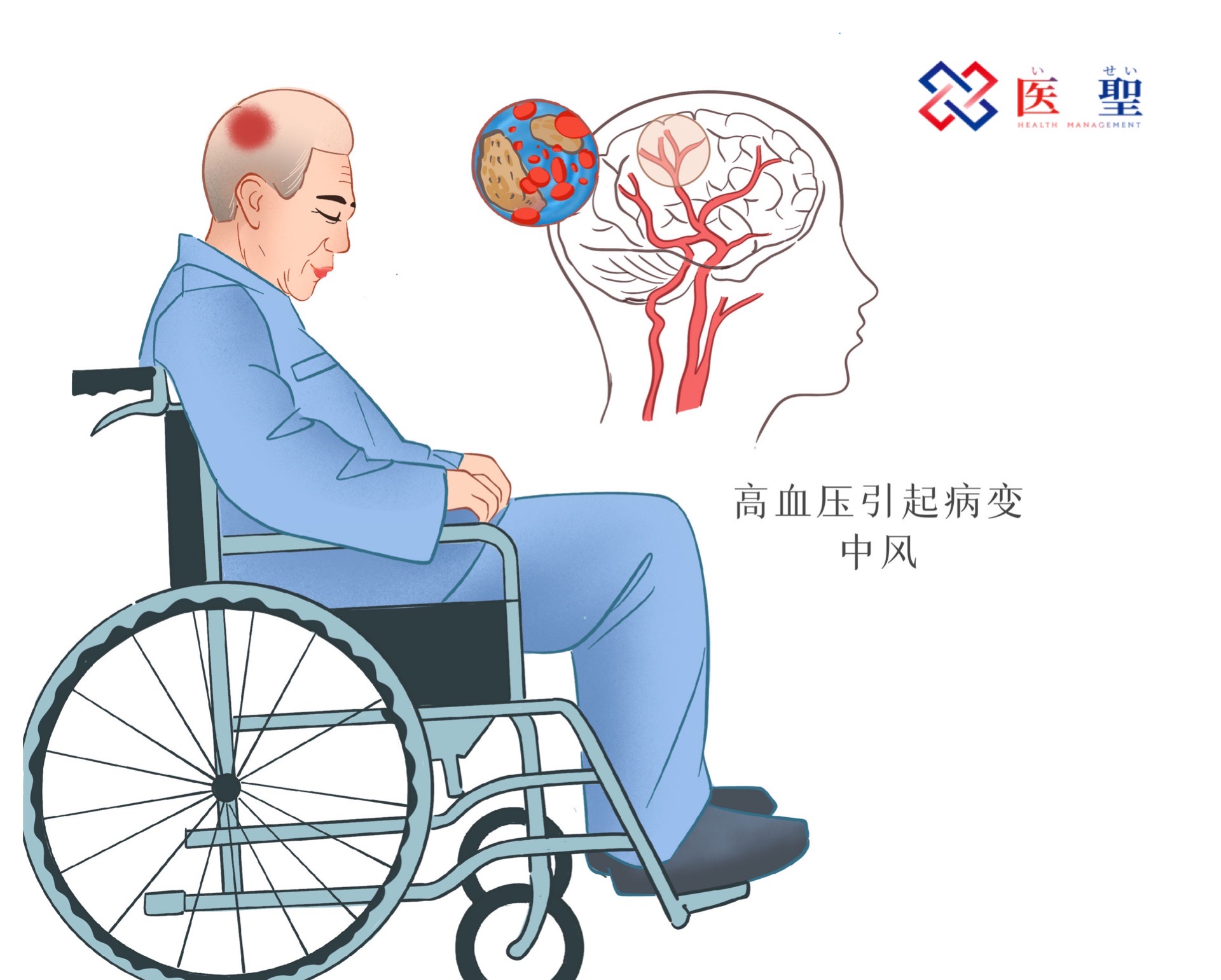 干细胞治疗高血压脑梗,干细胞再生医学治疗尿毒症