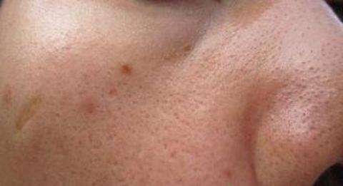 毛孔粗大怎么办教你一招根除,毛孔粗大怎么让毛孔变得细腻