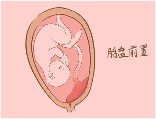 孕期出血别惊慌看看真相是什么,孕期出血怎么办专家教你正确应对