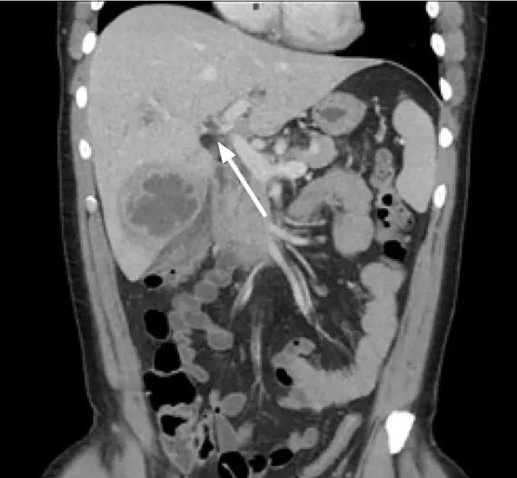 这种教科书中才有的阑尾炎并发症，击倒了强壮的健身教练