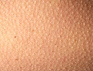 眼睛周围长特别痒小疙瘩怎么回事,女性眼睛周围长疙瘩是什么原因