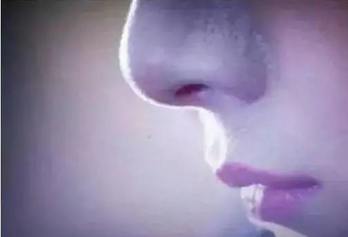 黑头多怎么办如何去除黑头,黑头贴去除顽固黑头