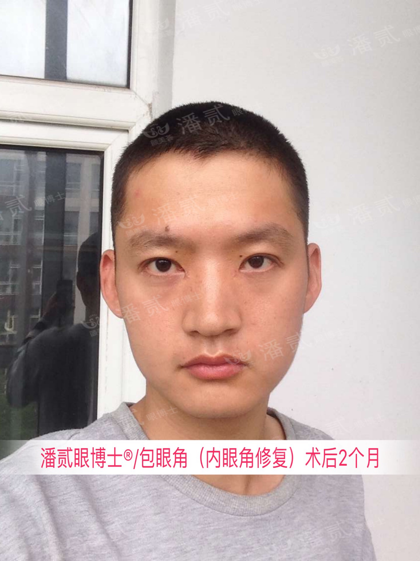 开内眼角会留疤的照片,开内眼角的疤痕变白色了怎么办