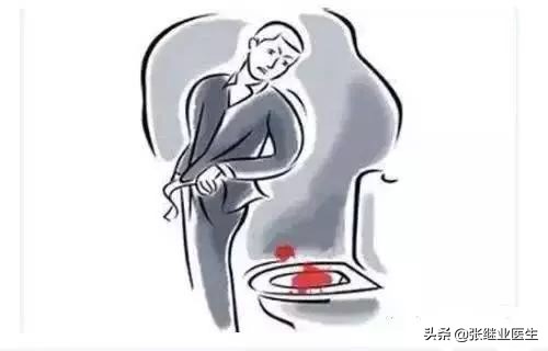 重视便血的早期诊疗,便血一定要重视吗