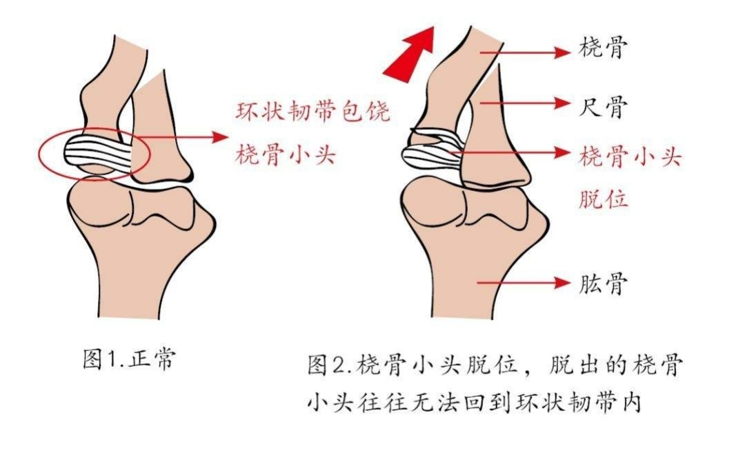 婴儿牵拉肘,小儿牵拉肘怎么办