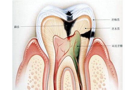 口腔科医生：什么是牙髓炎？牙髓炎主要有哪些症状？