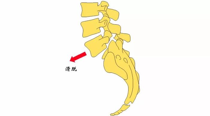 腰椎滑脱是什么原因引起的,腰椎滑脱1级腰痛下不来床