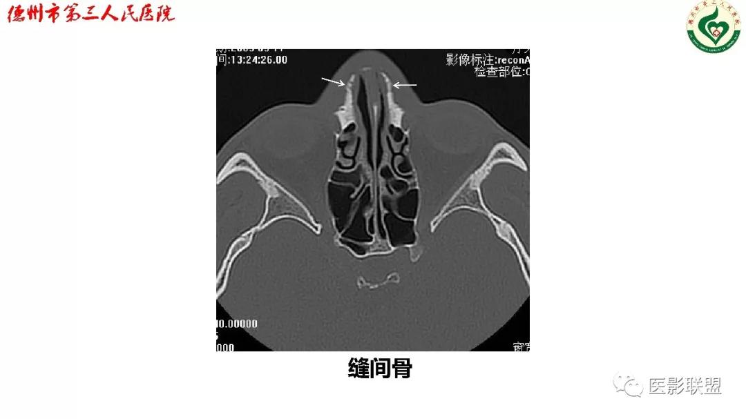 鼻骨骨折dr影像表现,鼻骨骨折影像学诊断