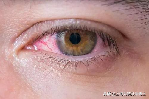 刚做完双眼皮闭眼总翻白眼正常吗,割了双眼皮为啥眼睛老流泪