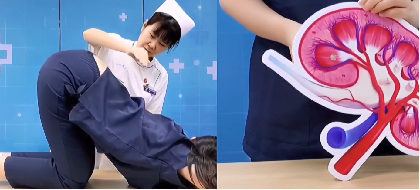 为什么肾结石掉下来肾里还有结石,肾下盏结石排石的正确方法