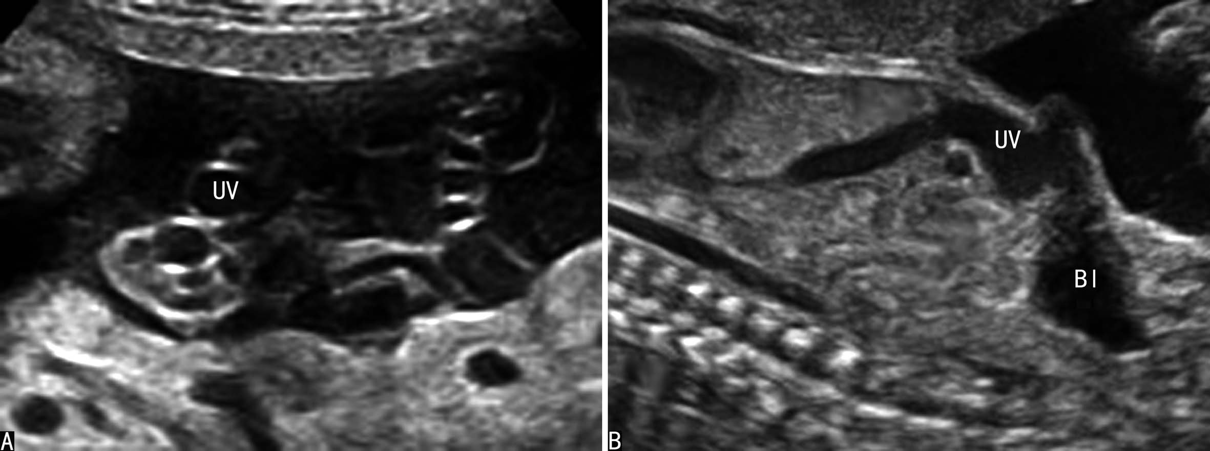 做高清彩超能看出脐带扭转吗,脐带超声异常