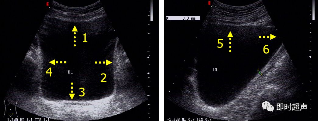 膀胱超声图解大全,膀胱超声解剖及常见病变超声表现