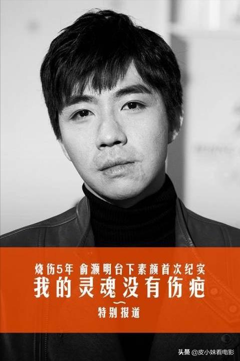 俞灏明是怎么被毁容的,从美男子到毁容俞灏明