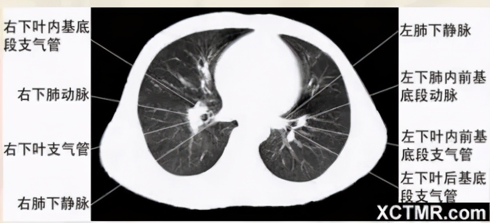 女性盆腔ct断层解剖结构图,女性盆腔脏器ct解剖