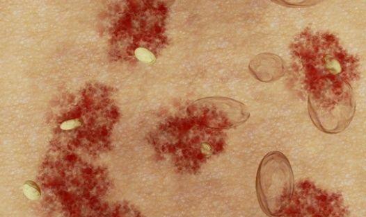 如何彻底消灭在痘痘里的螨虫,痘痘里面有米粒怎么全部去除