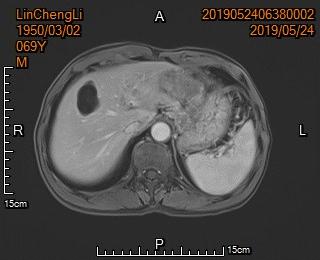 胃癌晚期化疗一次多少钱,胃癌晚期不化疗用靶向药