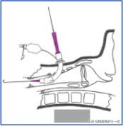 干货：气管切开术及护理措施