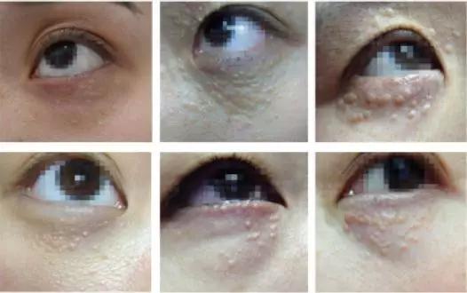 长了这么多年汗管瘤，你还以为是脂肪粒？