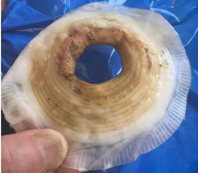 造口凹陷回缩护理视频,造口回纳术后的护理方法